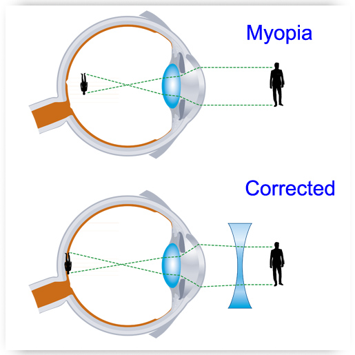 Myopia - Eye Care Centers | Morrisville - Durham - Henderson | Eye Exams