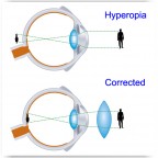 Hyperopia - Eye Exams | Optometrists |Oxford and Henderson NC