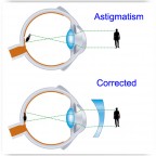 Astigmatism