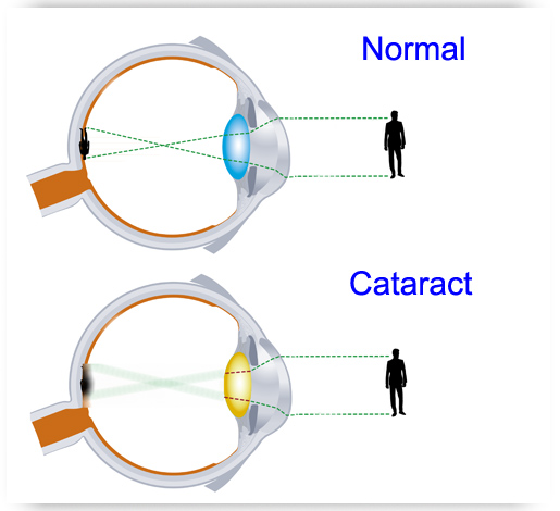 Cataracts - Eye Exams | Optometrists |Oxford and Henderson NC