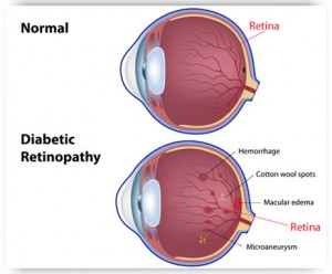 Diabetic Retinopathy - Eye Exams | Optometrists |Oxford and Henderson NC